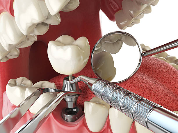 Best Emergency Wisdom Teeth Removal in Anchorage, KY